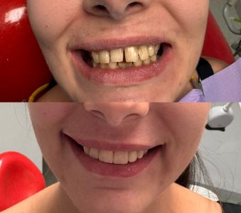 Dinți frumoși în câteva zile fără aparat dentar: fațetarea dinților