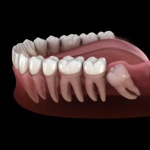 Extracția molarului de minte: ghid complet (inclusiv măsea de minte inclusă/neieșită pe arcadă) – stomatologie fără durere