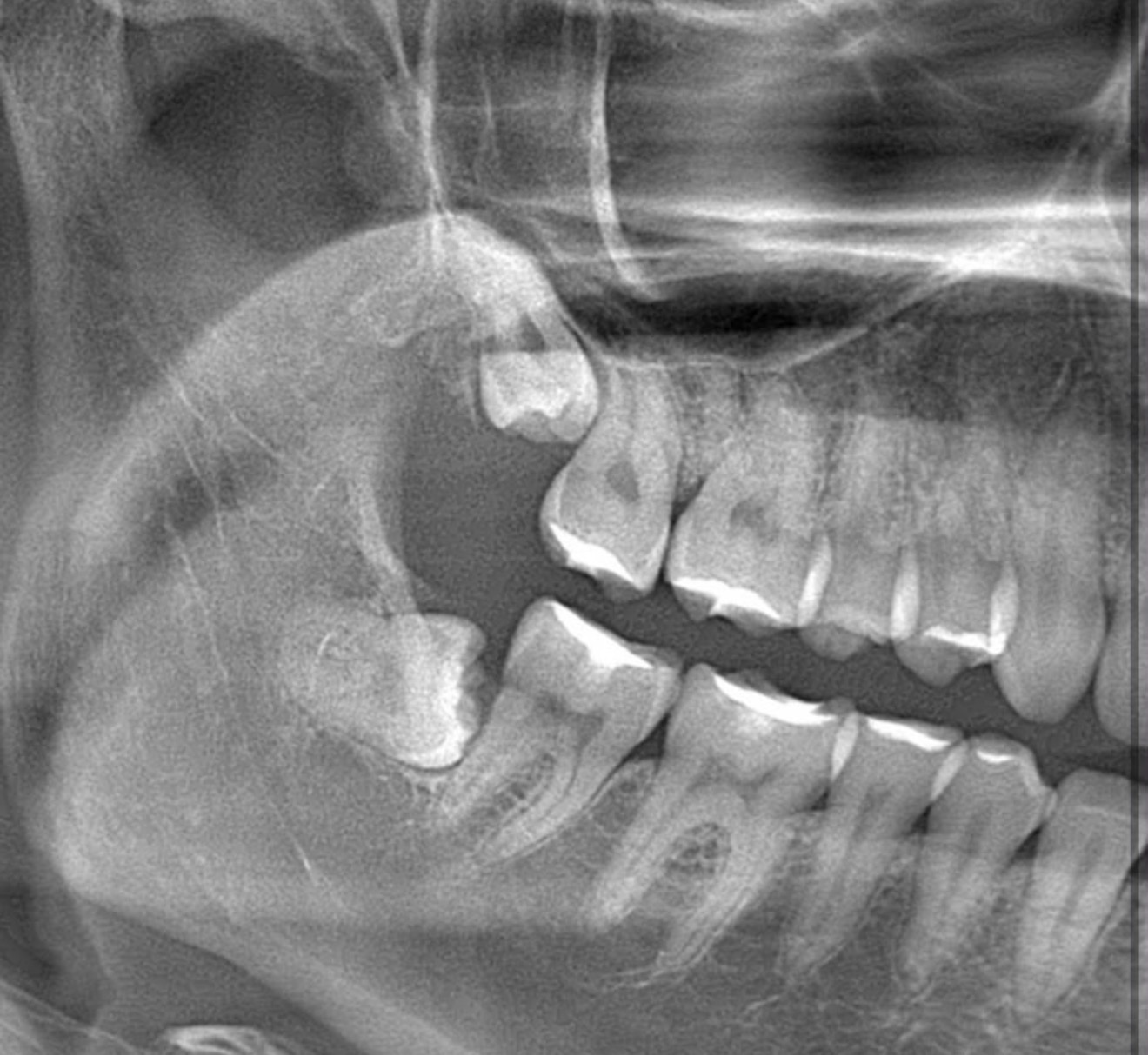 Radiografie masea de minte inclusa si pozitionata orizontal