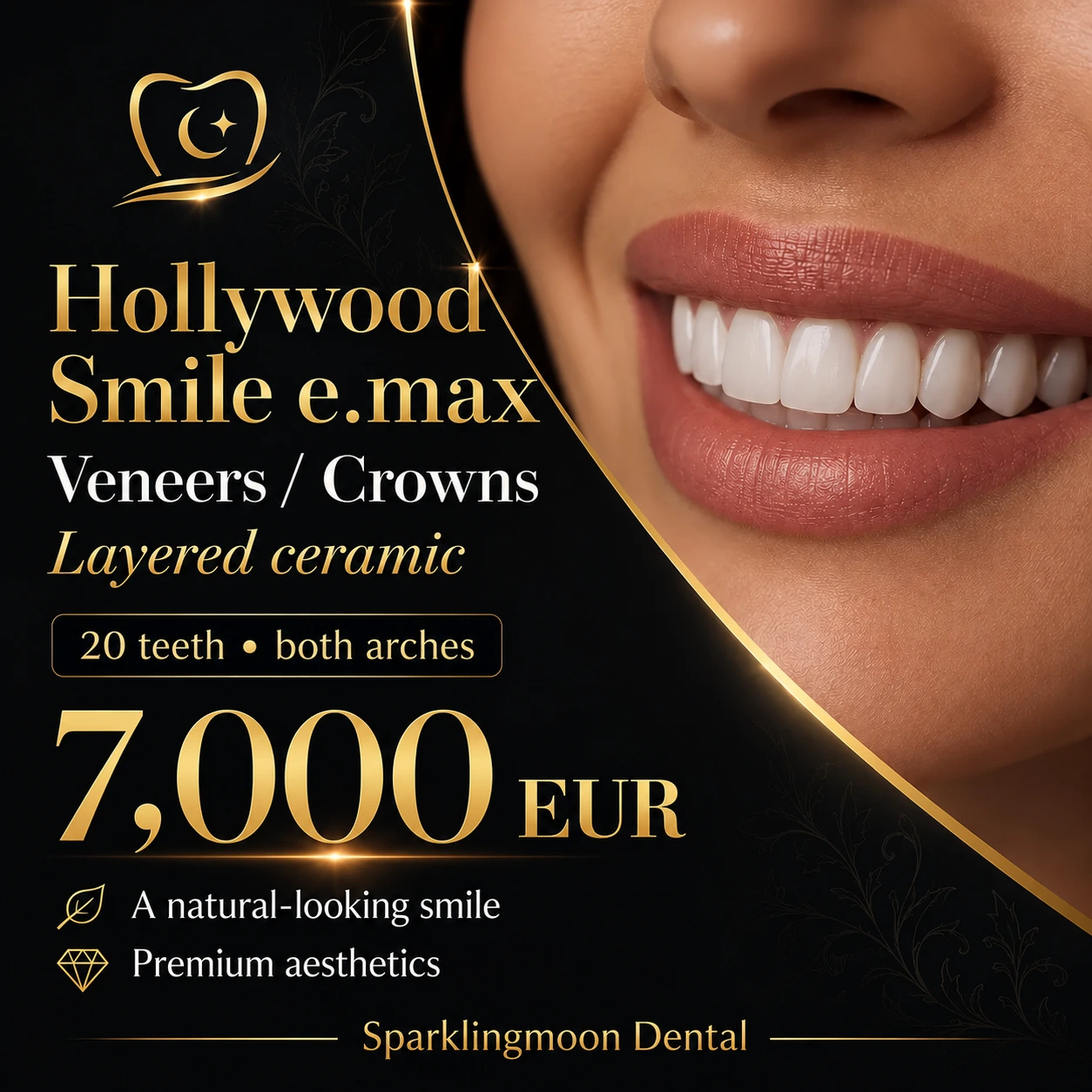 Sparklingmoon Dental: 20 E.max veneers or crowns, both arches, 7,000 EUR