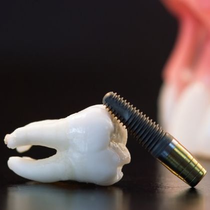 Implant dentar Megagen AnyRidge - Tehnologie Avansată pentru Stabilitate Maximă