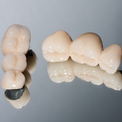 Coroană metalo-ceramică pe implant - Restaurare dentară fixă și durabilă