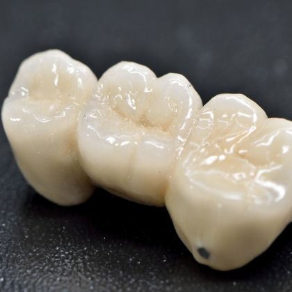 Coroană din zirconiu pe implant - Restaurare dentară estetică și durabilă | SparklingMoon Dental