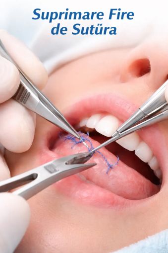 Suprimare fire de sutură (scos fire) – preț și indicații | Stomatolog, cabinet stomatologic Popești si Sector 4